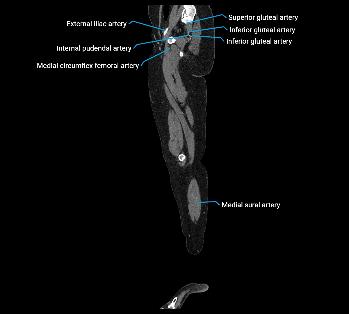 CTA lower limb sagittal cross sectional anatomy labelled image _22 (3).webp